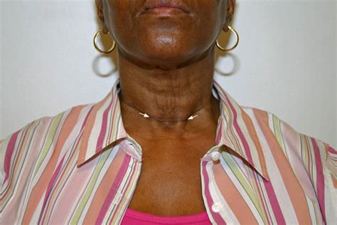 Thyroidectomy Scar Photos Thyroid Cancer Surgery Scars Endocrine