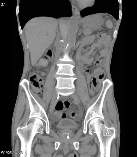 Hemosuccus Pancreaticus Image Radiopaedia Org