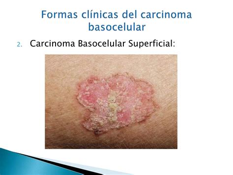 Carcinoma Basocelular Y Espinocelular Ppt