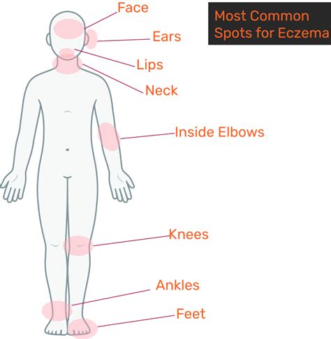 Eczema (Atopic Dermatitis) - SimcoDerm