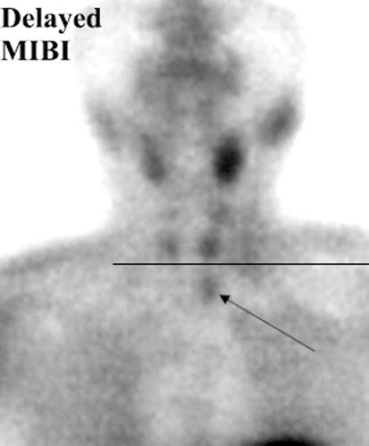 Radionuclide Imaging Of The Parathyroid Glands Patterns Pearls And