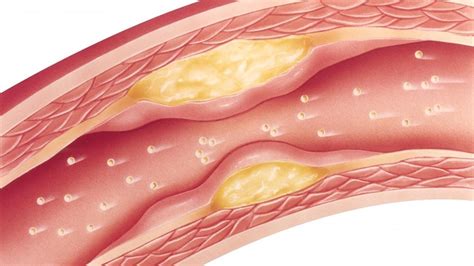 Ésta es la nueva técnica que puede reducir el colesterol con una dosis