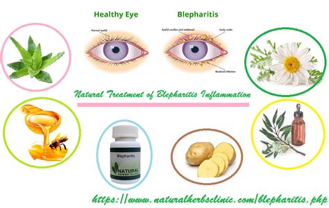 Natural Treatment For Blepharitis Yu