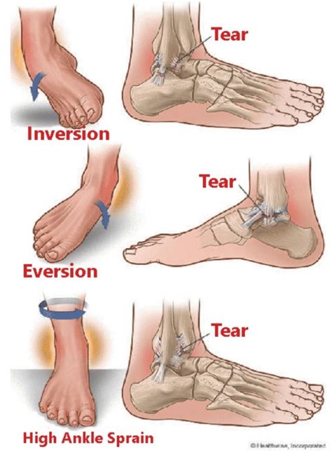 Types Of Ankle Sprains