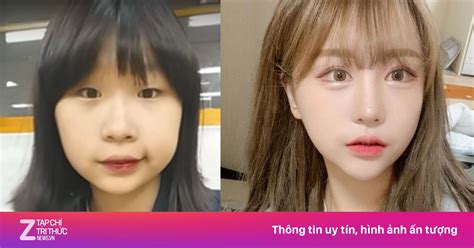 Hot girl Hàn Quốc phẫu thuật thẩm mỹ toàn cơ thể Giới trẻ ZNEWS VN