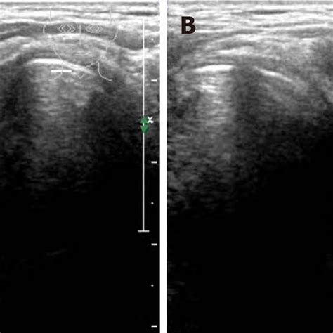 Right Thyroid Sonogram A Left Thyroid Sonogram B Both A And B Show