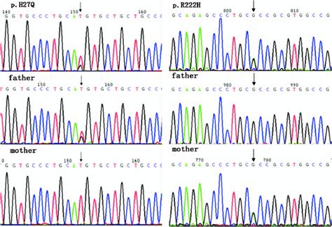 The Sanger Sequencing Revealed Novel Compound Heterozygous Mutations Of