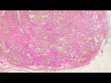 Transrectal Biopsy