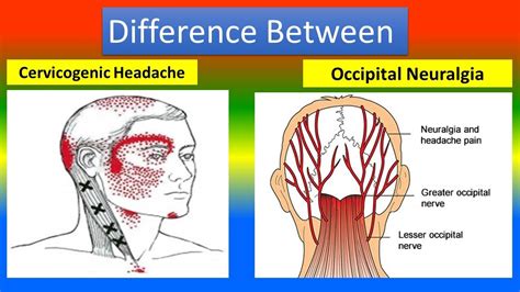 Difference Between Cervicogenic And Occipital Neuralgia Youtube