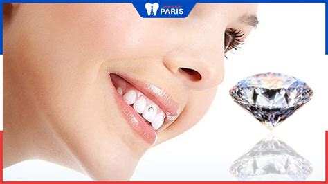 Gắn Kim Cương Lên Răng Có đắt Không Thưa Nha Sỹ Nha Khoa Paris