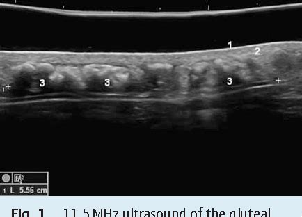 Figure From Tumoral Calcinosis Of The Gluteal Region In A Year Old