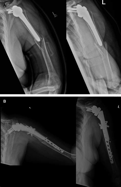 Evaluation And Treatment Of Postoperative Periprosthetic Humeral