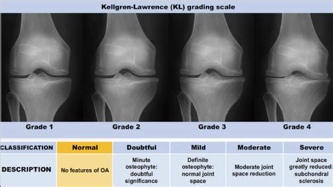 Knee Pathology Flashcards Quizlet