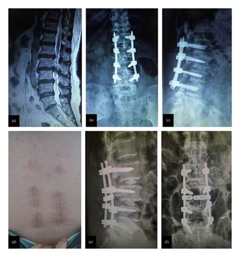 Minimally Invasive Transforaminal Lumbar Interbody Fusion Versus Download Scientific Diagram