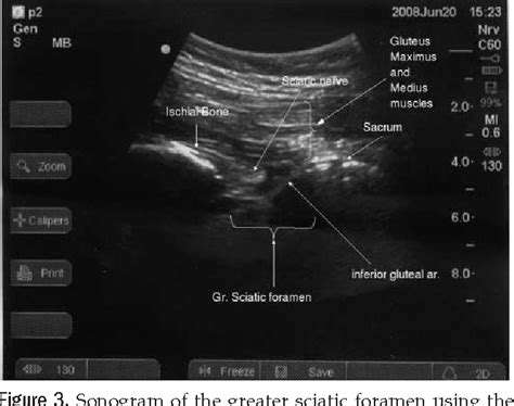 Ultrasound localization of the sacral plexus using a parasacral ...