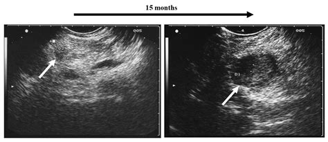 Relevance Of Endoscopic Ultrasound In Endocrinology Today Multiple