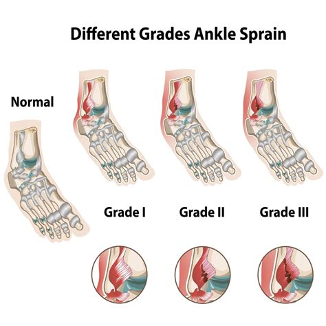 Understanding Ankle Sprains: Causes, Symptoms, & Recovery