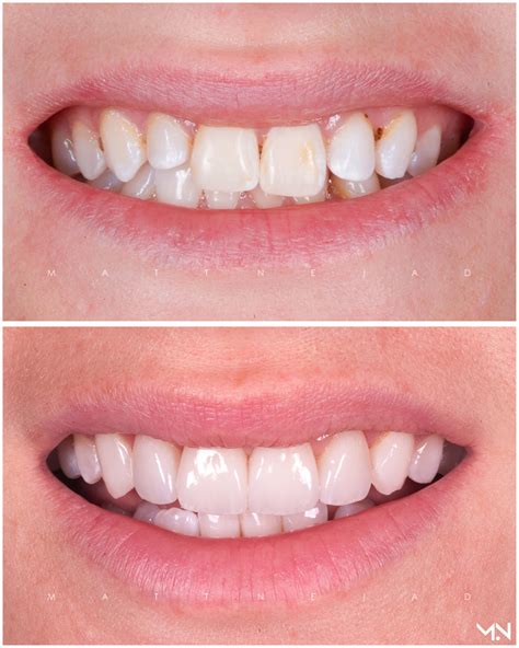 Cosmetic Smile Makeover To Enhance Smile Cosmetic Smile Makeover To