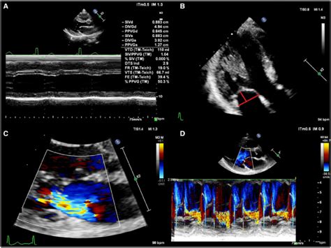 A Parasternal Long Axis Views By Two Dimensional Guided M Mode