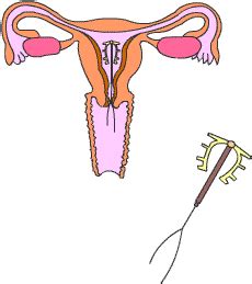 Poderosas Falando Sério: Métodos contraceptivos: DIU 