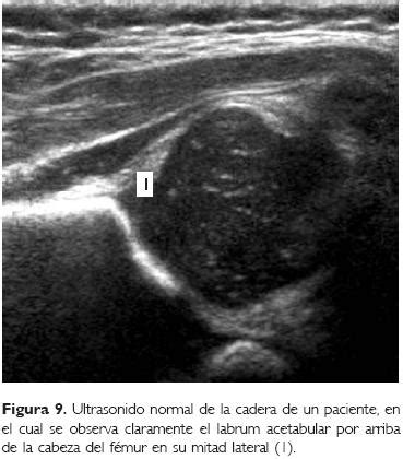 Ultrasonido Ortop Dico De La Cadera Infantil