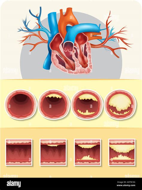 Diagram showing fat in human heart Stock Vector Image & Art - Alamy