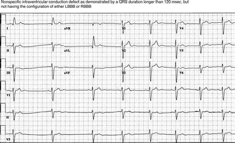 Chamber Abnormalities And Intraventricular Conduction Defects