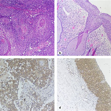 Detail Of A Squamous Cervical Carcinoma Hematoxylin And Eosin Hande × Download Scientific