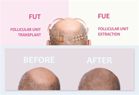 Discover Fue Hair Transplants At Zestige The Ultimate Guide