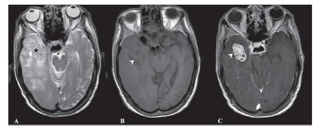 Comparison of MRI findings of glioblastoma and gliosarcoma – can ...