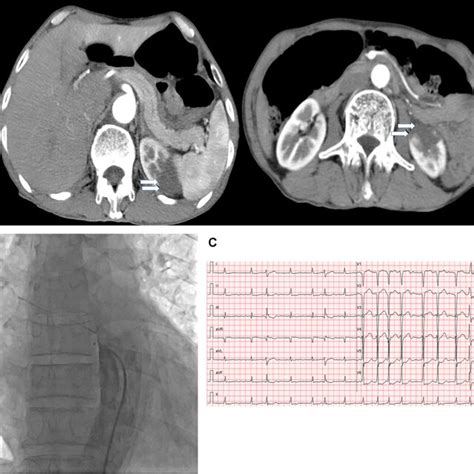 Contrast Enhanced Computed Tomography Ct Scans Of The Abdomen With