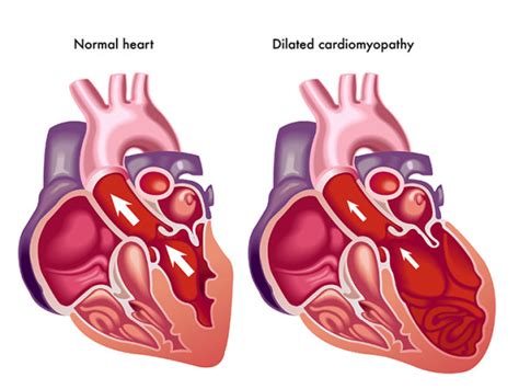 What Are Treatment Options for An Enlarged Heart? – Kiasalon