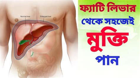 ফ্যাটি লিভারের লক্ষণ ফ্যাটি লিভার কি ও কেন হয় Fatty Liver