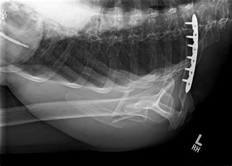 Case Study Shoulder Pain Following A Bicycle Accident Clinical Pain