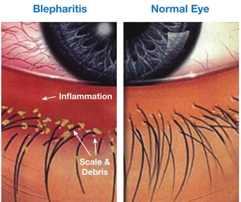 Blepharitis - Eye Doctors