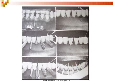 Splinting Part I Certified Fixed Orthodontic Courses By Indian Denta