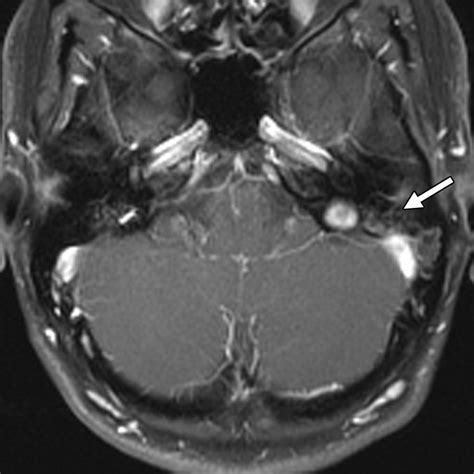 Mastoid Air Cells Mri