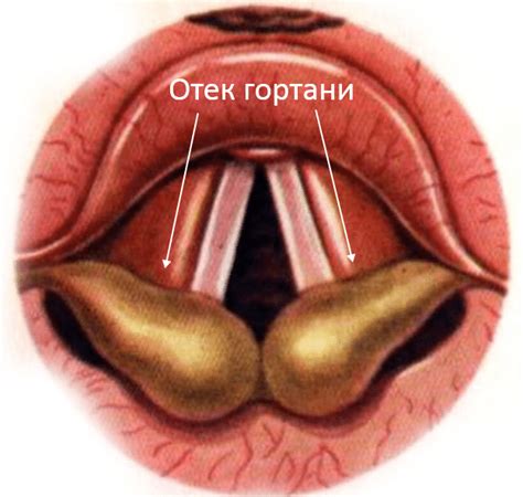 Отек гортани симптомы и лечение в домашних условиях