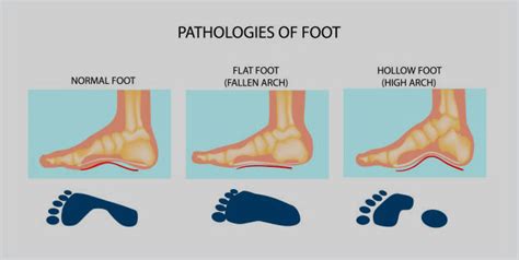 Flat Feet Condition Know Types And Tips For Treatment OnlyMyHealth