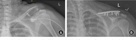 Figure From A Modified Method Of Augmented Distal Clavicle Fracture