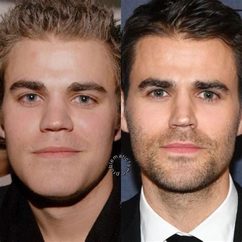 Male Celebrity Before And After Plastic Surgery