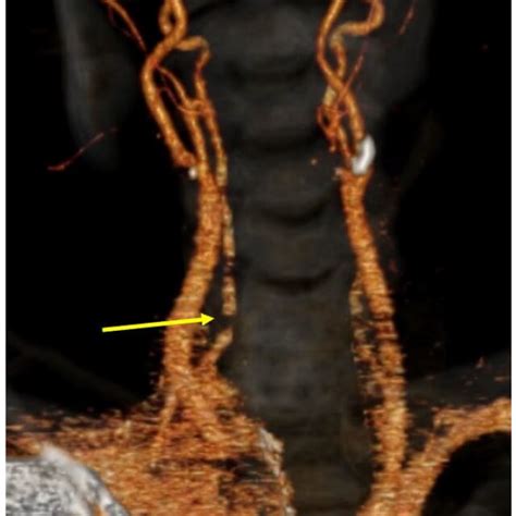 Ct Angiogram Showing Medial Displacement Of Right Vertebral Artery