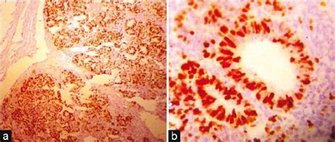 A Low Power View Of Very High Ki 67 Labeling Index In The Epithelial Download Scientific