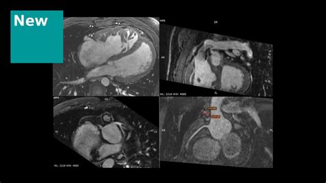 Cardiovascular MRI Siemens Healthineers