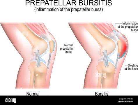 Bursite Pr Patellaire Inflammation De La Bursa Pr Patellaire