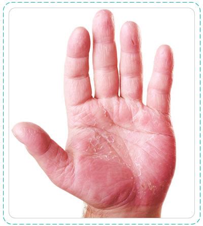 Hand Allergy Causes – Hand Allergy Gloves