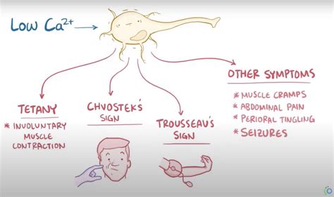 Hypocalcemia Symptoms And Signs