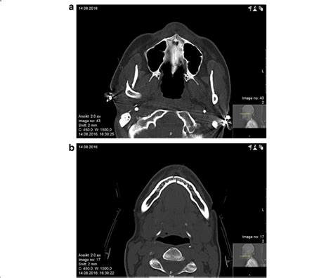 A B Computed Tomography Scan At Admittance Shows Fractures Of The