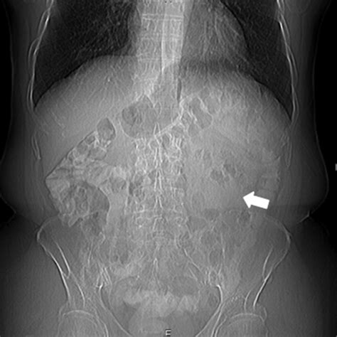 Another Reason For Abdominal Pain Mesenteric Panniculitis Bmj Case Reports