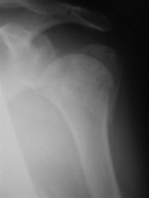 Four Part Valgus Impacted Proximal Humeral Fracture Presenting Three